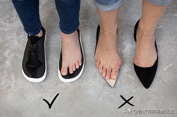 大脚骨是骨质增生吗,大脚骨是什么脚型