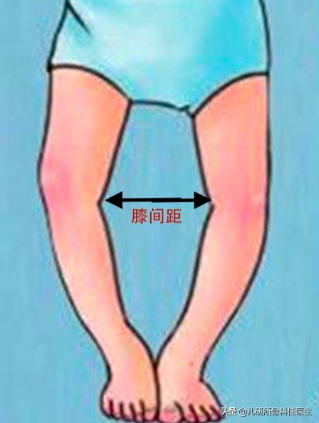 孩子走路太早对腿有什么伤害,宝宝站立早会罗圈腿吗