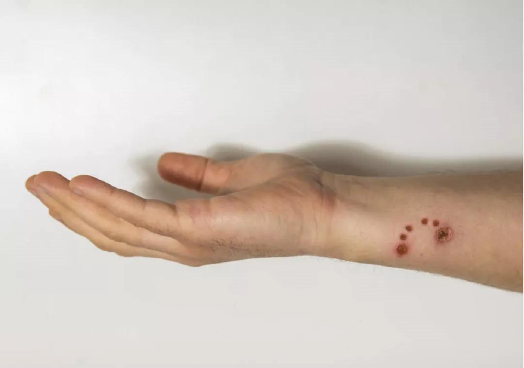 得了狂犬病恐惧症的表现,得了狂犬病恐惧症