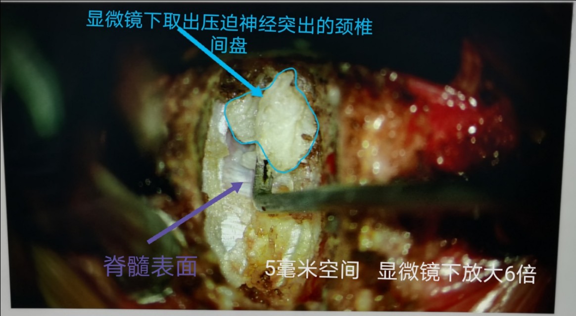 疫情期间颈椎病发作怎么办,疫情间躺久了头昏眼胀怎么治