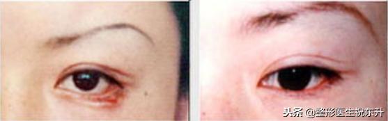割眼袋导致下睑外翻怎么修复,祛眼袋以后凹陷的原因