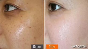 选择光电祛斑，出门再也不担心颜值掉线