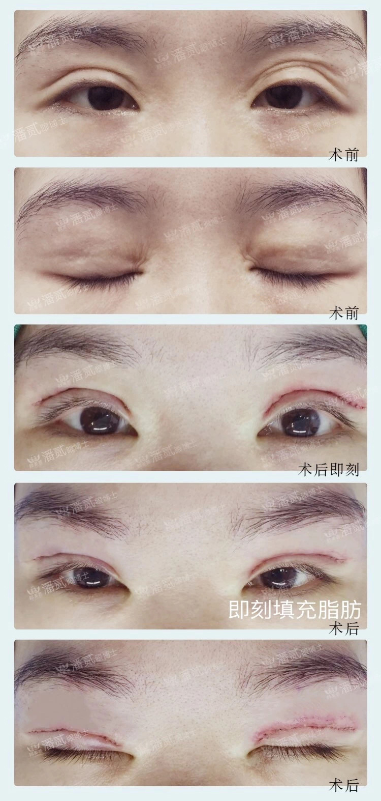 双眼皮失败的女孩,双眼皮失败做成了三眼皮好修复吗