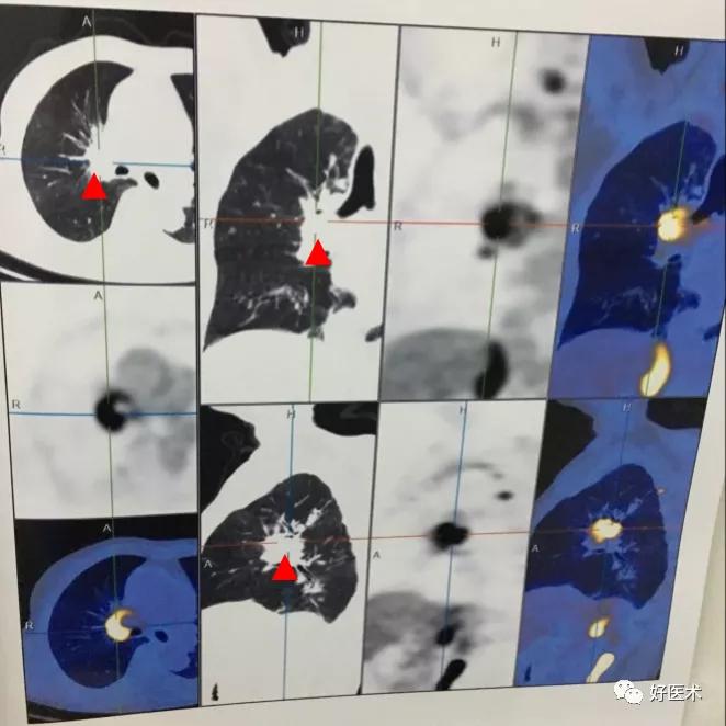 腰部ct需要注意事项,做腰部ct需要注意的事项