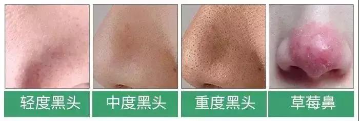 亲测真正有效去黑头粉刺产品,黑头连根拔起还会再长吗