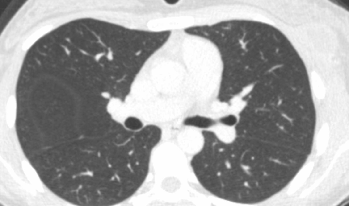 结核杆菌会引起肺结节吗,肺结节诊断为肺结核