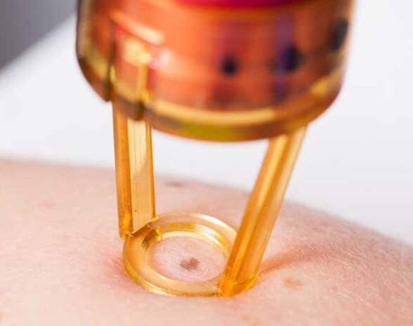 医生忠告四不做,医生提醒这几种痣要警惕