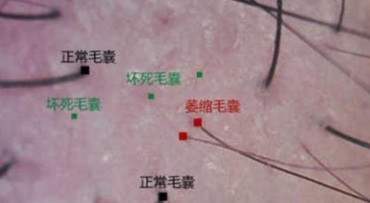 毛囊检测告诉你毛囊萎缩,头皮检测和毛囊检测有区别吗
