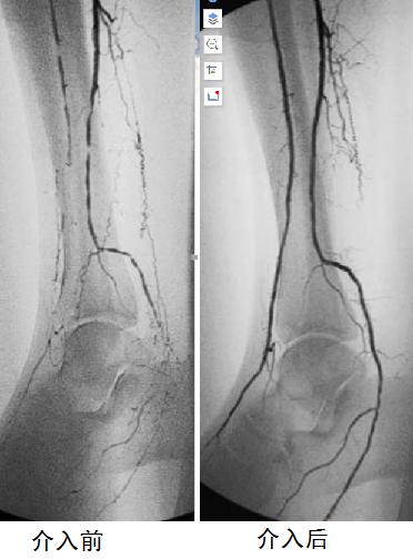 血管被堵怎么办？别怕！微创介入诊疗已有多种腔内开通手段！