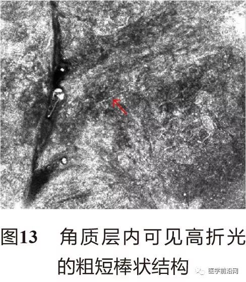 皮肤共聚焦显微镜能查什么,皮肤镜和共聚焦显微镜