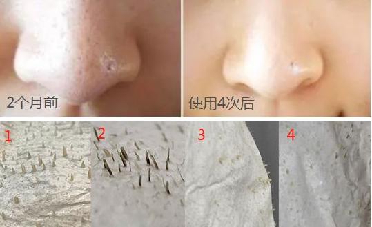 自吸黑头机,全自动吸黑头机