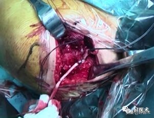 治疗肩锁关节脱位，有最好的方法吗？