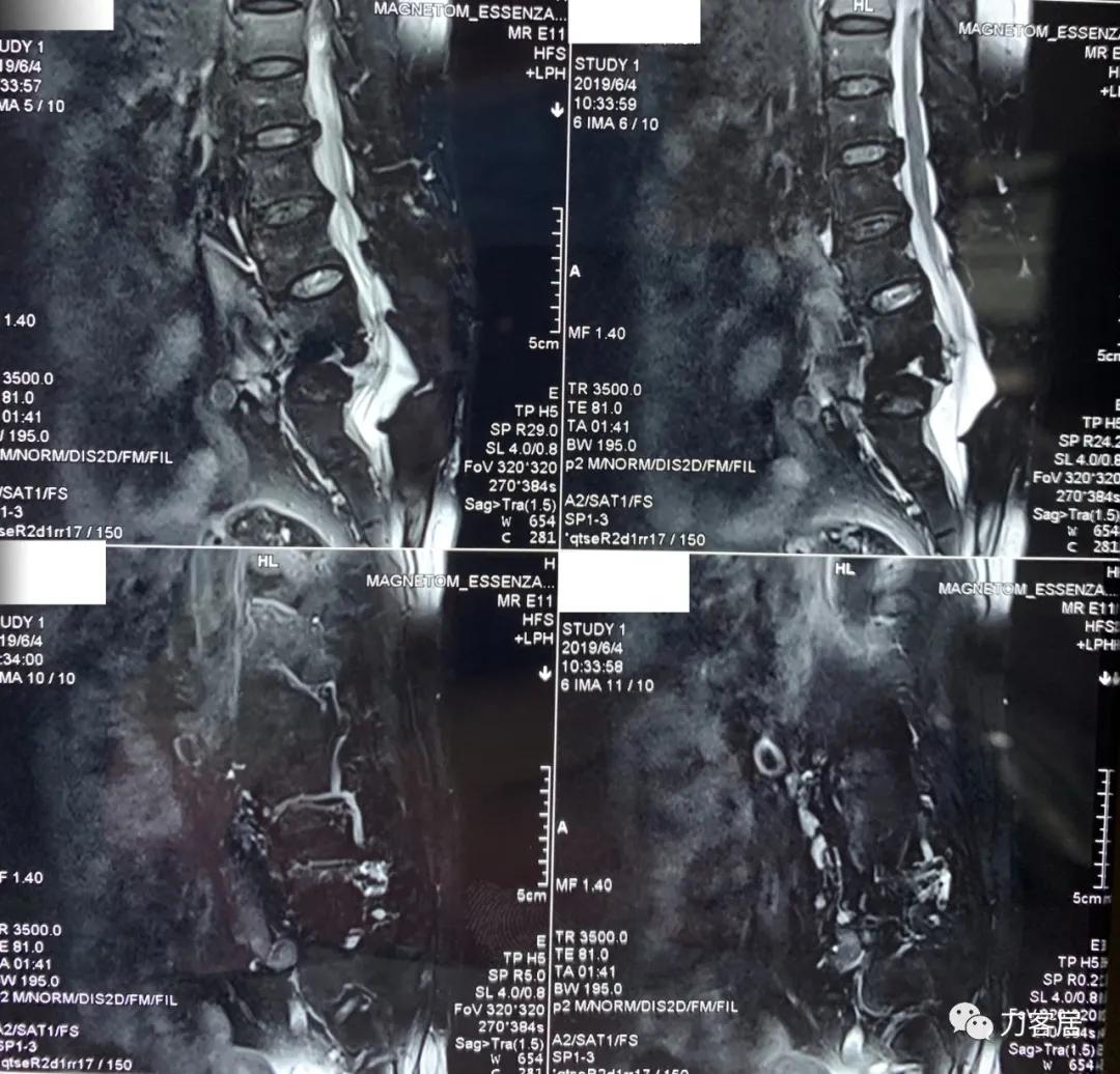 腰椎结核手术没有清病灶,腰椎结核术后不排气