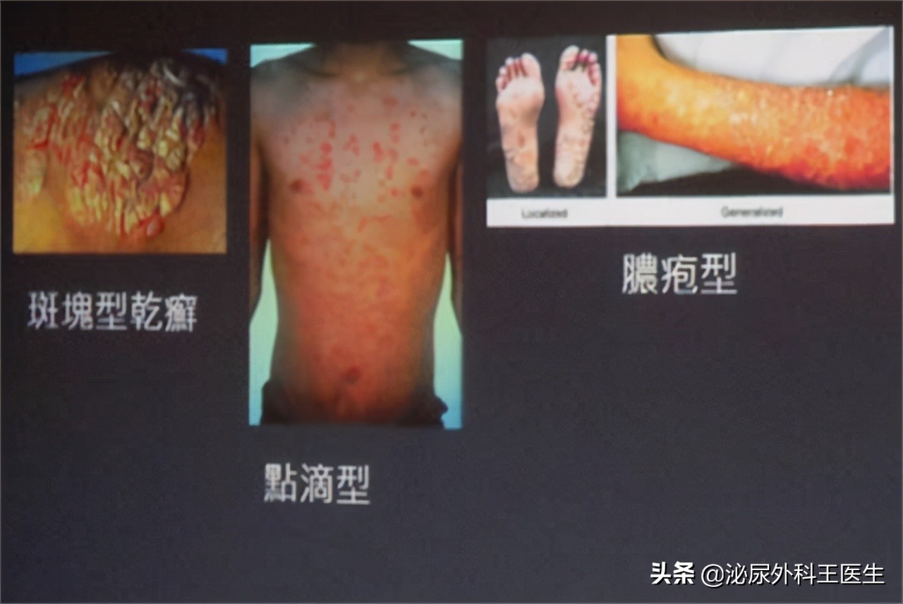 小腿瘙痒是不是糖尿病的并发症,糖尿病胳膊腿瘙痒是并发症严重了