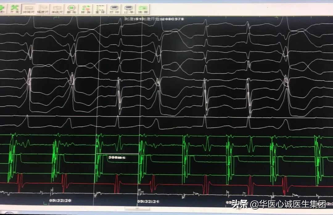 窦性心动过速查房,攀钢集团总医院心内科
