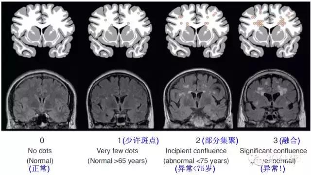 大脑深部白质区见斑点状异常信号,脑白质病变建议mri检查是什么意思