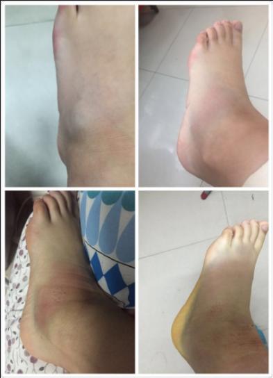 吉大一院和二院足踝外科哪个好,吉大二院足踝科医生名单