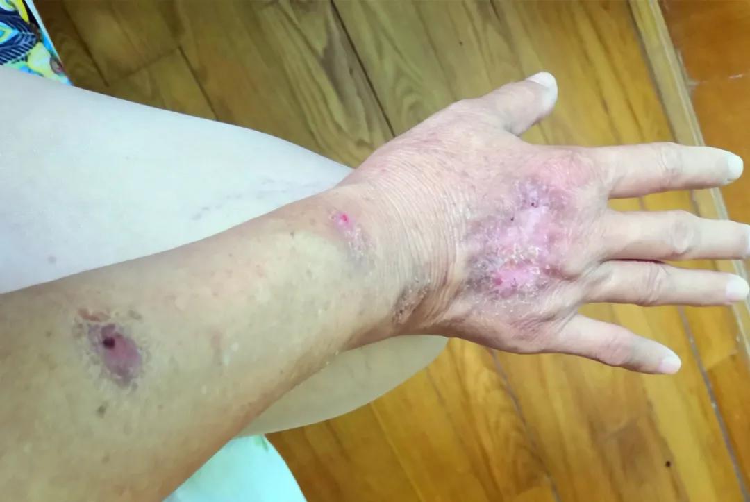 被螃蟹夹一下结果直接进了医院,被螃蟹夹进医院