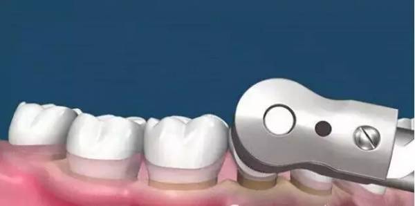 洗牙到底怎么洗好,洗牙洗的不干净