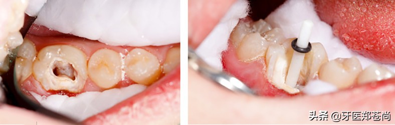 做完根管治疗可以不戴牙冠吗,为什么做完根管治疗一定要做牙冠