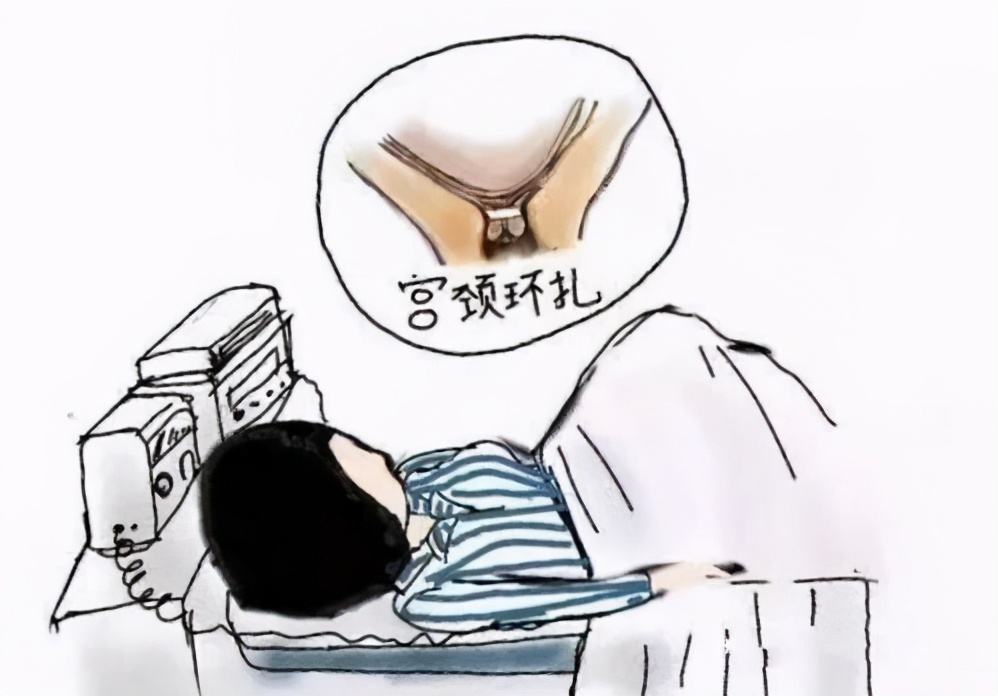 先天性宫颈机能不全是孕晚期疾病,宫颈机能不全是早产多还是流产多