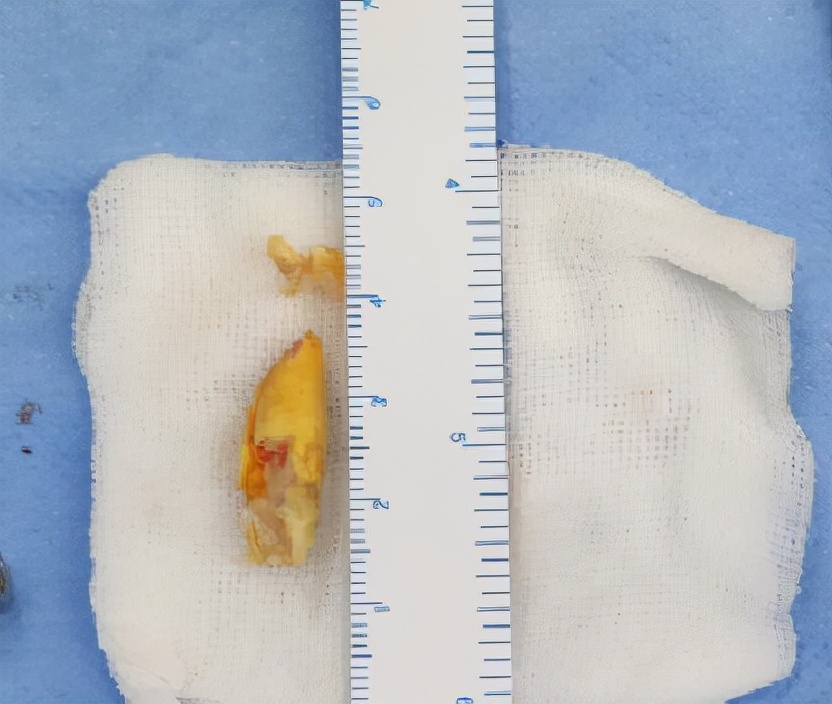 颈动脉血管狭窄怎么办呀,颈动脉狭窄最好解决办法