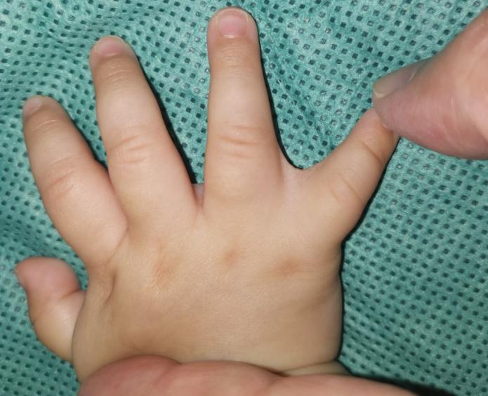 并指畸形免植皮案例,并指畸形