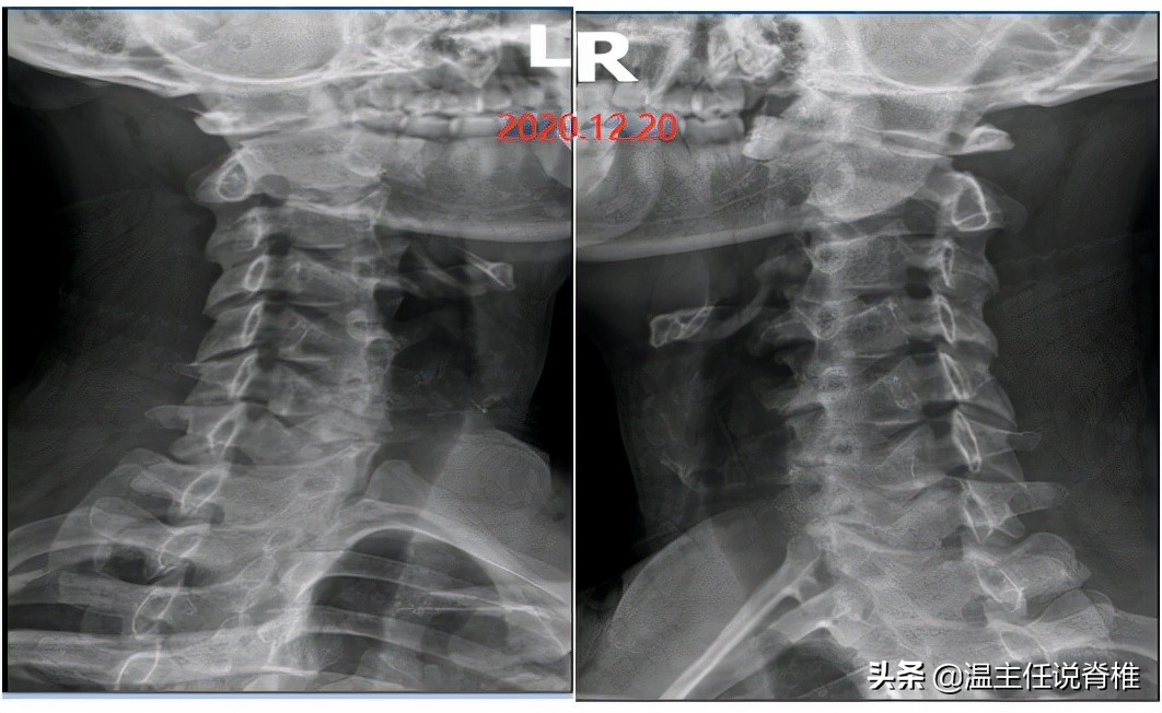 外科医生做脊椎手术,脊椎病保守治疗