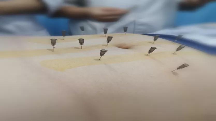 丨康复馆丨现代都市人首选减肥法——埋线减肥