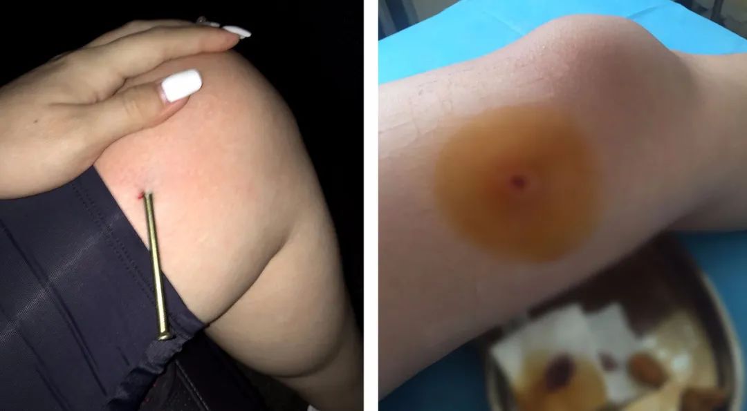 儿童手指夹伤怎么处理,三岁女童手指被压断后续