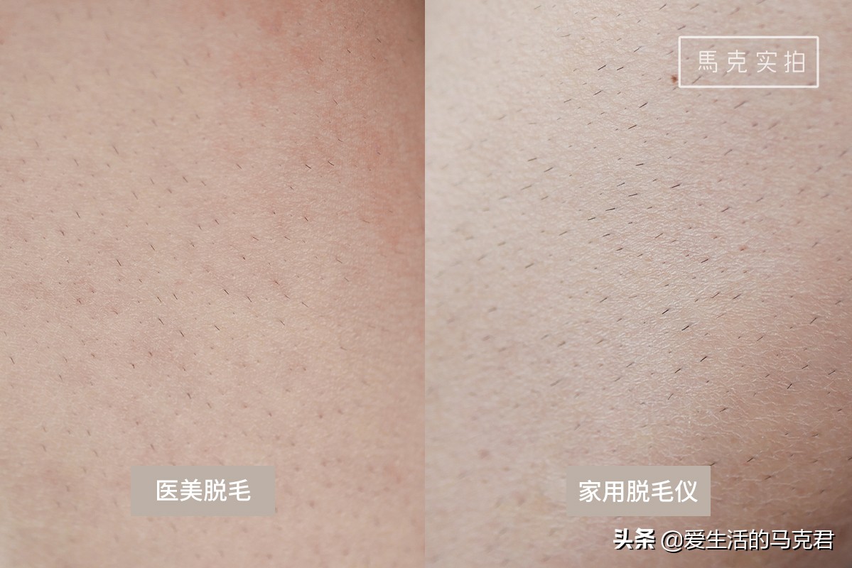 家用脱毛仪哪个牌子脱毛效果最好,家用激光脱毛仪是智商税吗