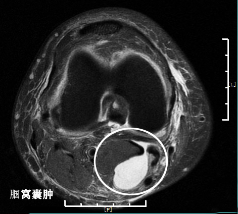 膝关节核磁共振报告单上怎么看,膝关节核磁正常报告单