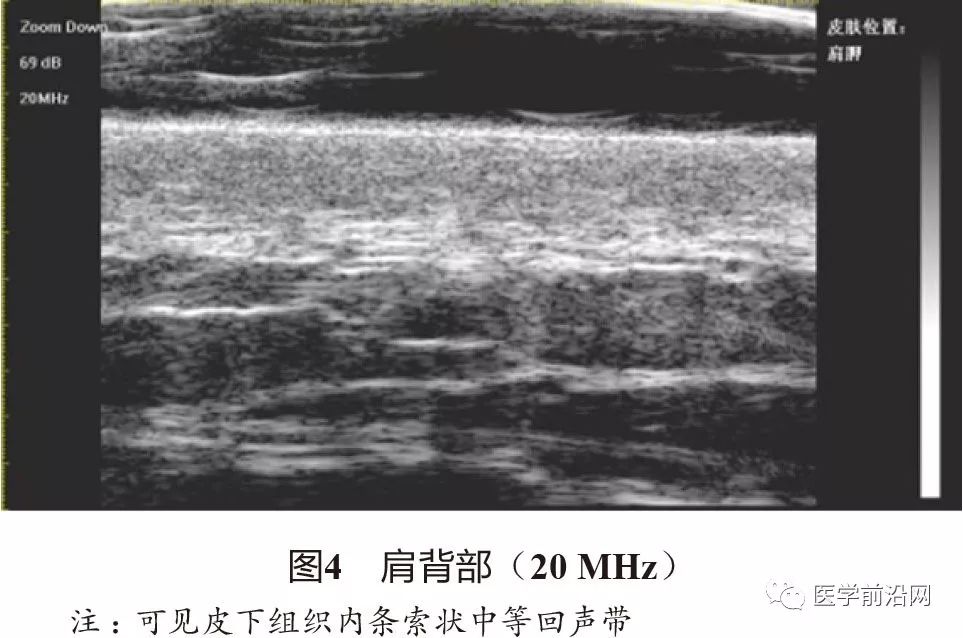 常见皮肤病高频皮肤超声诊断专家共识全文发布