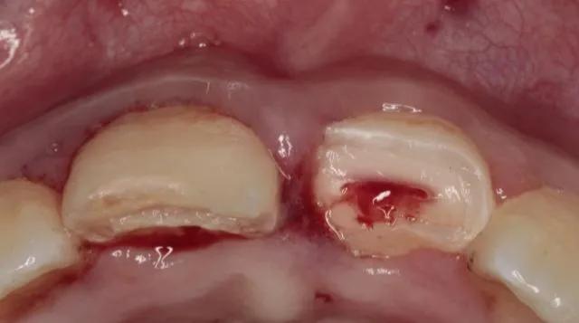 什么情况要做根管治疗,根管治疗是怎么样一个过程
