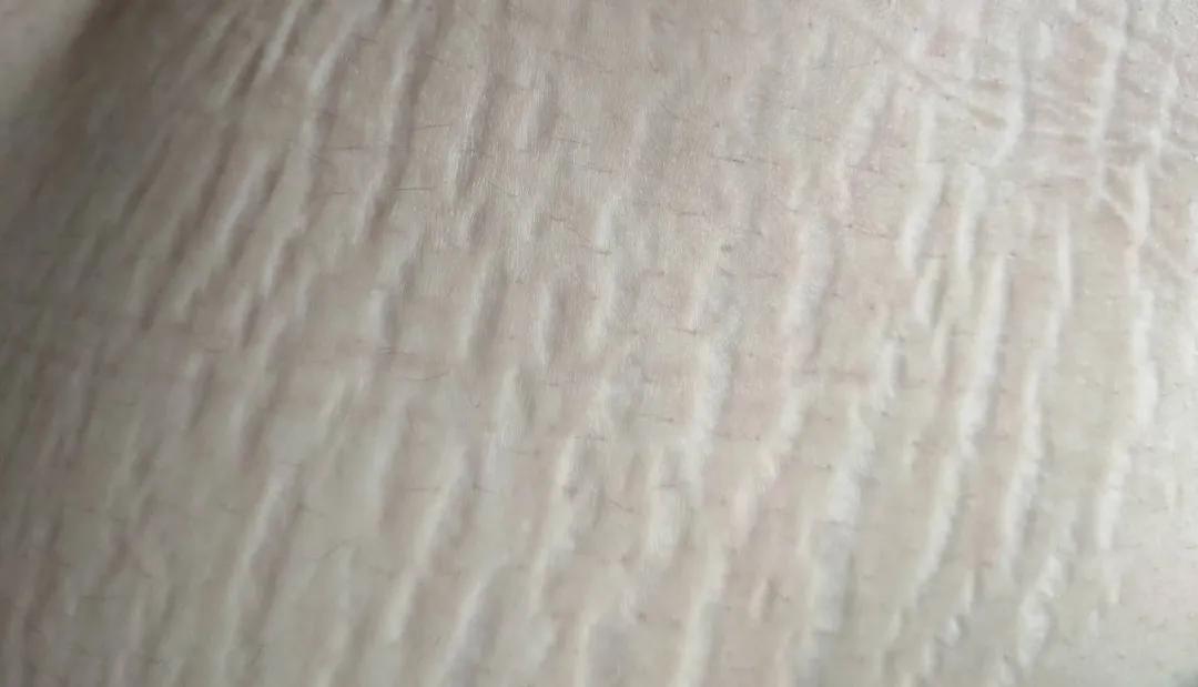 网上卖的妊娠纹修复霜真的有用吗,预防妊娠纹涂的是智商税吗