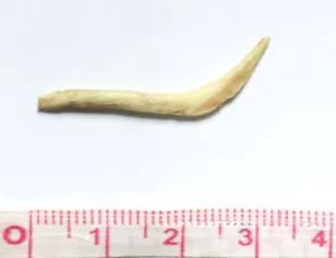 一碗鱼汤,让她反复咳嗽、发烧,还发生了食管、气管“短路”