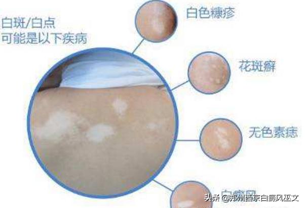 儿童白斑误诊为白癜风,小儿白癜风和局限性白癜风症状