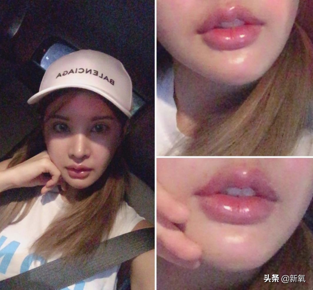 18岁土肥圆豪掷800万全身整形，鼻子6次大整假体穿出，效果却超美