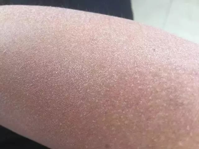 夏天了手脚干裂还有老茧,手脚干裂脱皮老茧用什么药膏