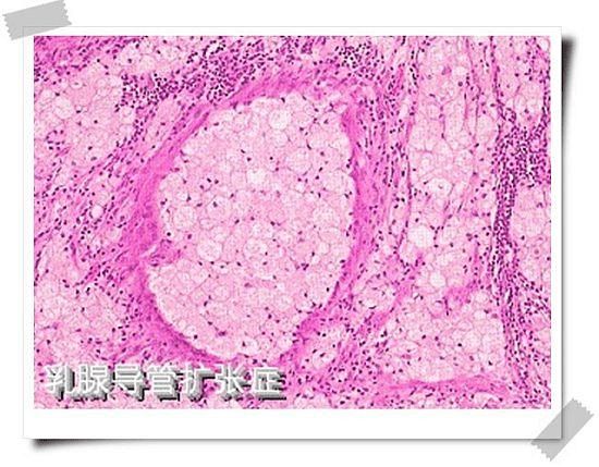 右乳低回声进一步检查什么,右乳低回声区内回声不均