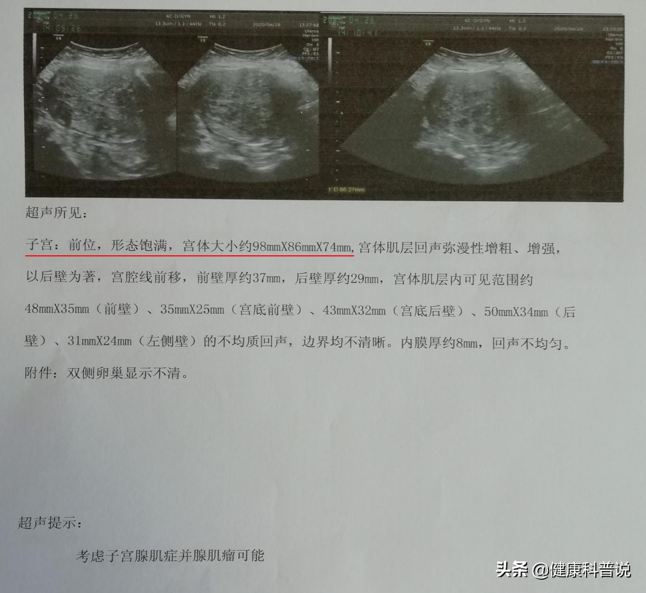 痛经和淋漓不尽折磨着她，打针上环都没用，保宫手术后症状消失