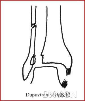 几种严重骨折医学名称,常见的骨折有哪些名称