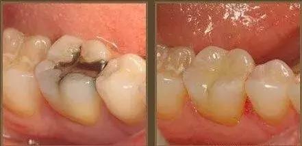 牙齿烂了一半为什么不能补牙,牙齿缺了一半补牙要多少钱