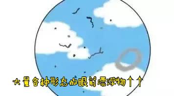 飞蚊症眼前有黑影原因,眼睛看到飞蚊症是怎么回事