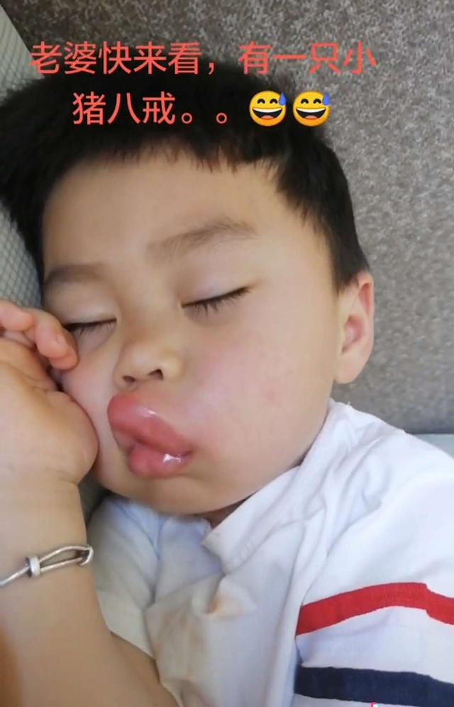 男童被蚊子咬后变成香肠嘴,小孩嘴巴被蚊子亲成香肠怎么办