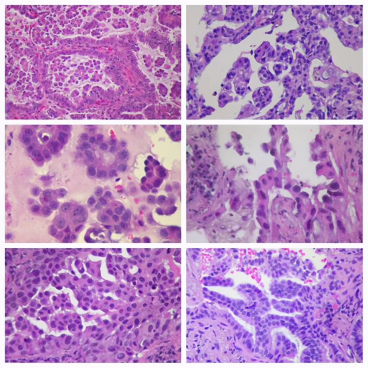 肺癌化疗与靶向治疗哪个好,肺癌靶向药物冲突吗