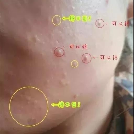 满脸都是闭口,满脸都是闭口的状态