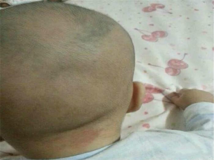 新生宝宝囟门跳动不明显,宝宝囟门受到撞击会影响智商吗