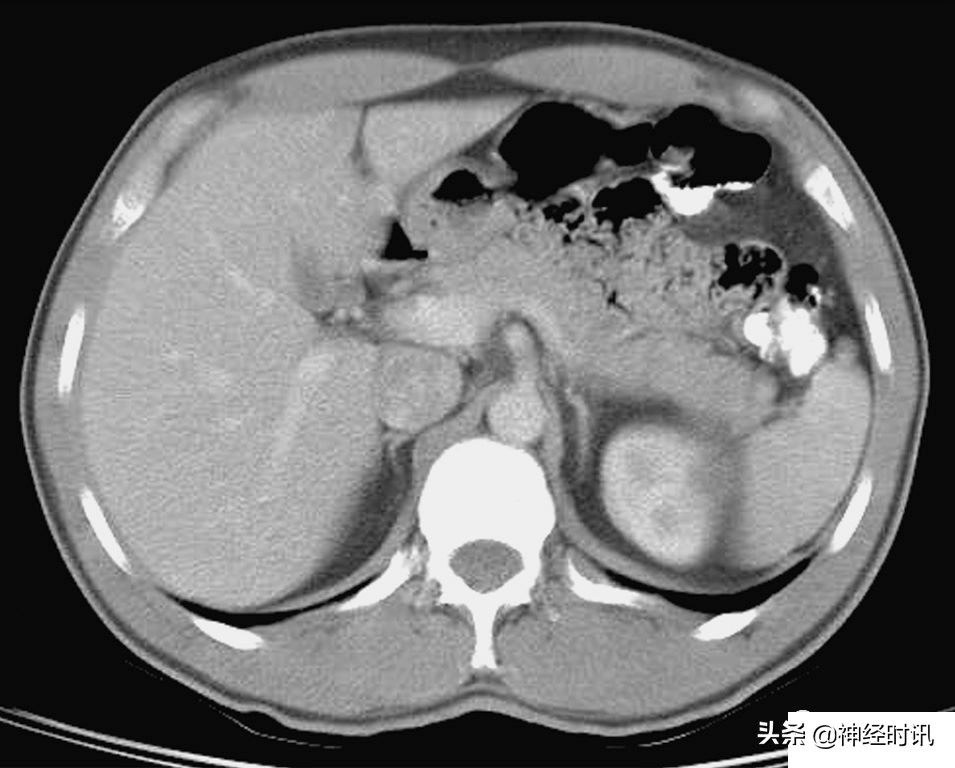 肾脏输尿管膀胱前列腺结构,肾输尿管膀胱解剖示意图
