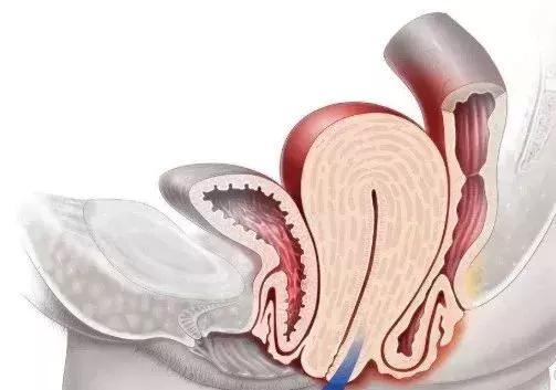 正确使用束缚带快速恢复魔鬼身材,日本产后束缚带